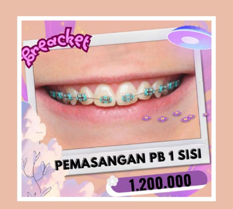 Pasang behel gigi asia 1juta