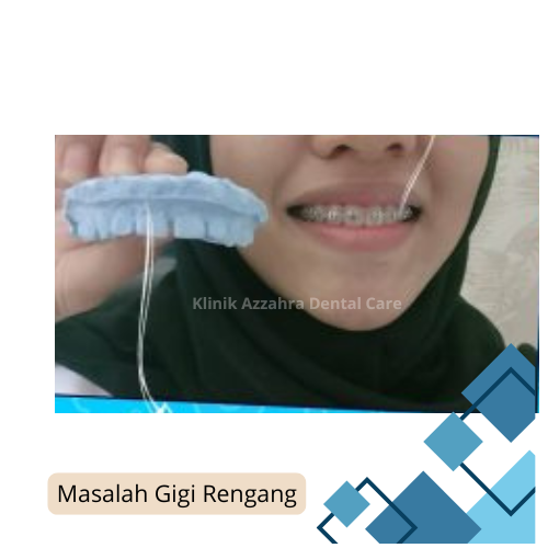 bentuk gigi renggang